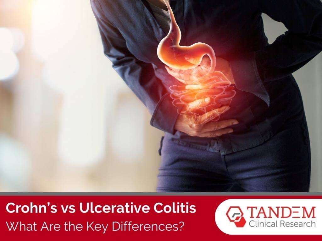 Crohn’s vs Ulcerative Colitis — What Are the Key Differences? by