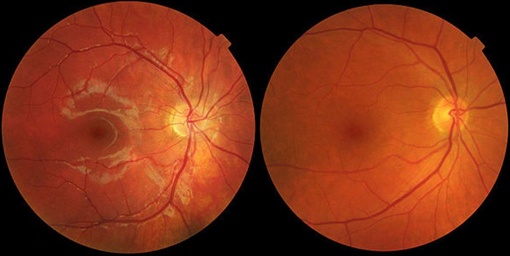Guide about Age Related Macular Degeneration — AMD | by Arsalan Rashid ...