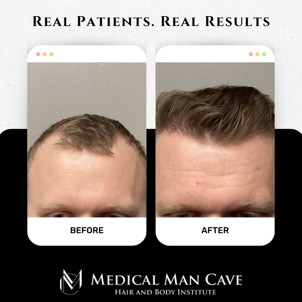 Achieve NaturalLooking Hair with FUE Hair Transplant in San Diego by