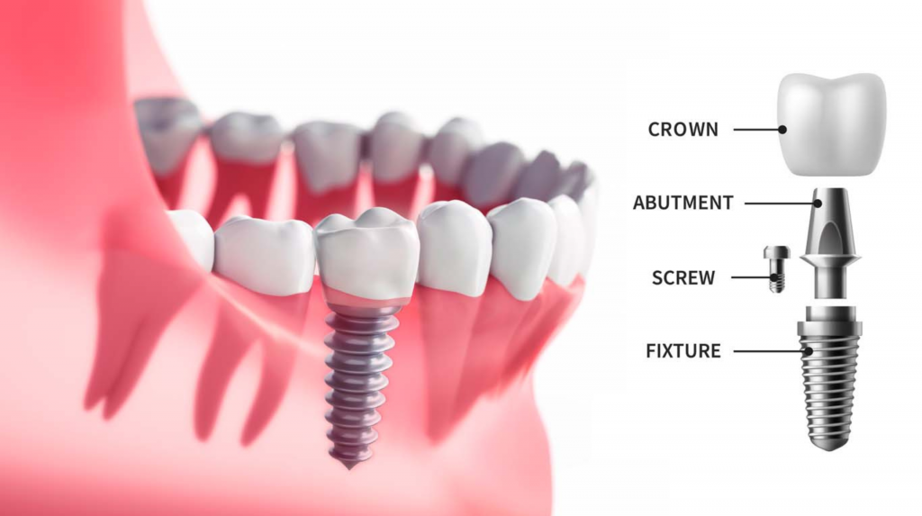 A Comprehensive Guide to Dental Care in Lakemba, Campsie, Ashfield