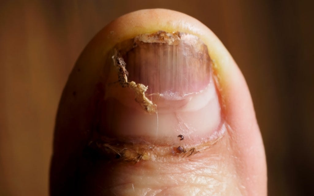 The Most Effective Treatment For Toenail Fungus Medium The most effective treatment for toenail fungus medium