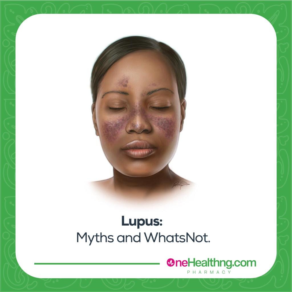 Lupus: The Myths and Whatnot…. SLE — (Systemic Lupus Erythematosus ...