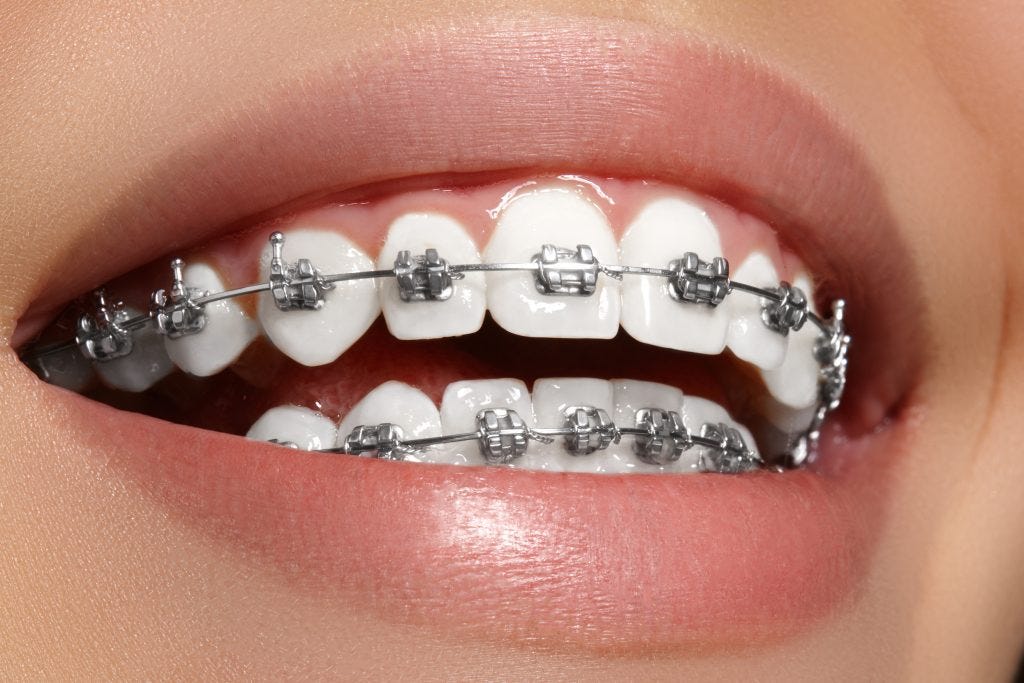 Ceramic Braces for Every Smile Dubai’s Inclusive Orthodontic Solutions