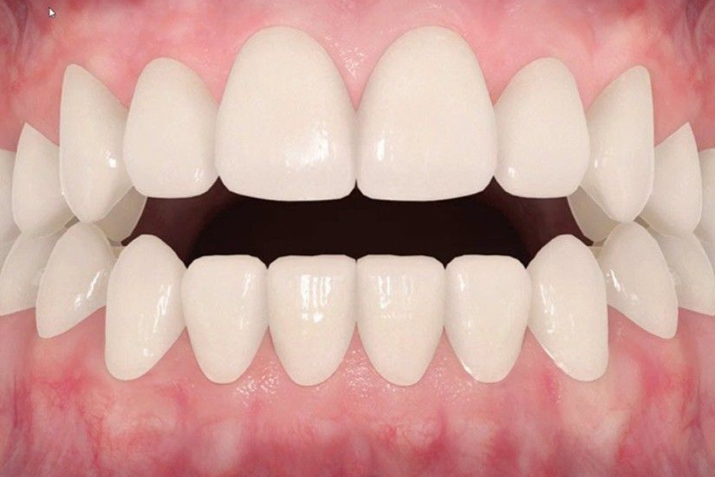Invisalign Treatment Gurgaon