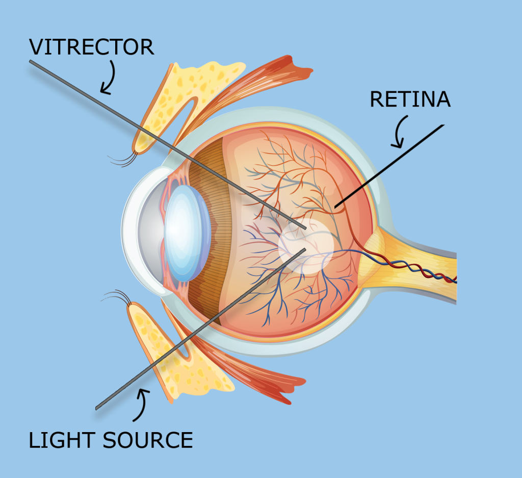 vitrectomy-fraser-eye-care-center