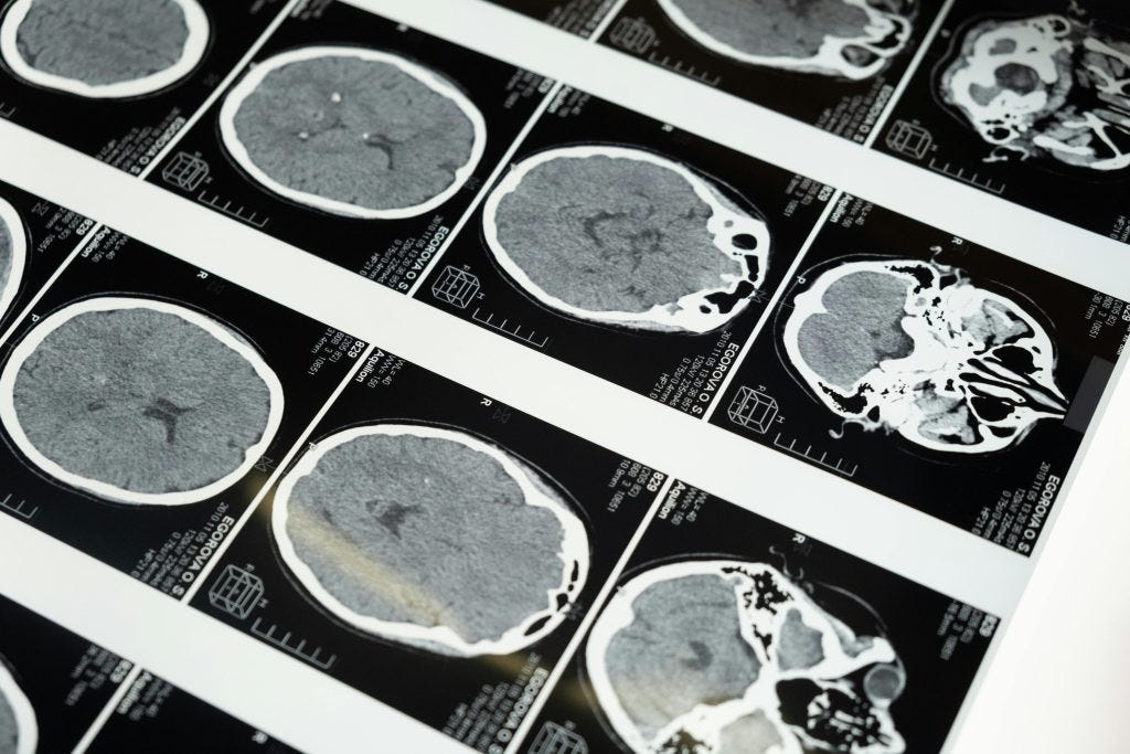 The Parkinson’s “GPS” Found: Why the SCAN Network Changes Everything