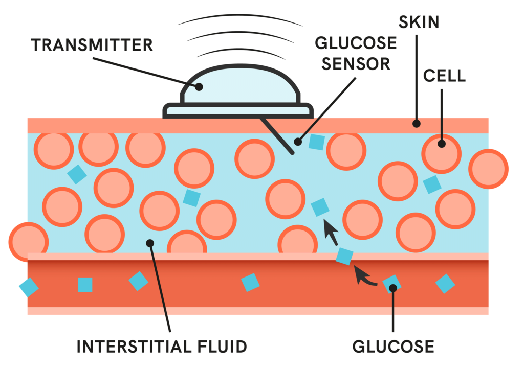 A Beginner’s Guide to Continuous Glucose Monitors (CGMs) and Their Role