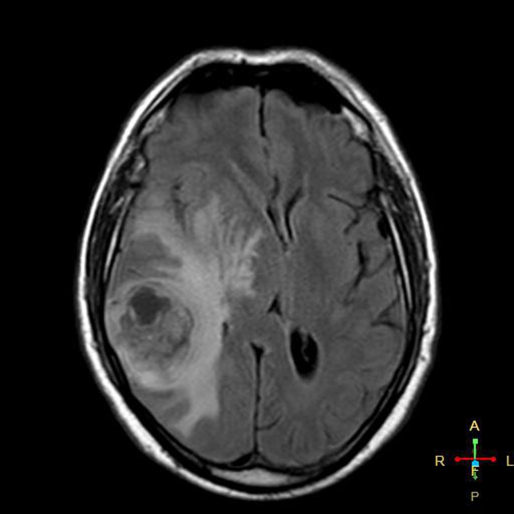 Глиальная опухоль головного. Опухоль мозга глиобластома. Глиобластома головного мозга мрт. Злокачественная глиобластома головного мозга снимок.