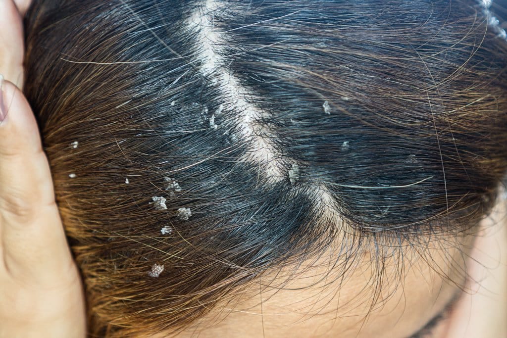 Flaky, Itchy Scalp