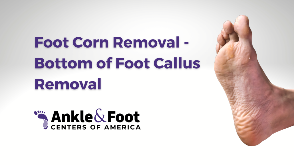 Top 4 Methods of Foot Callus Removal