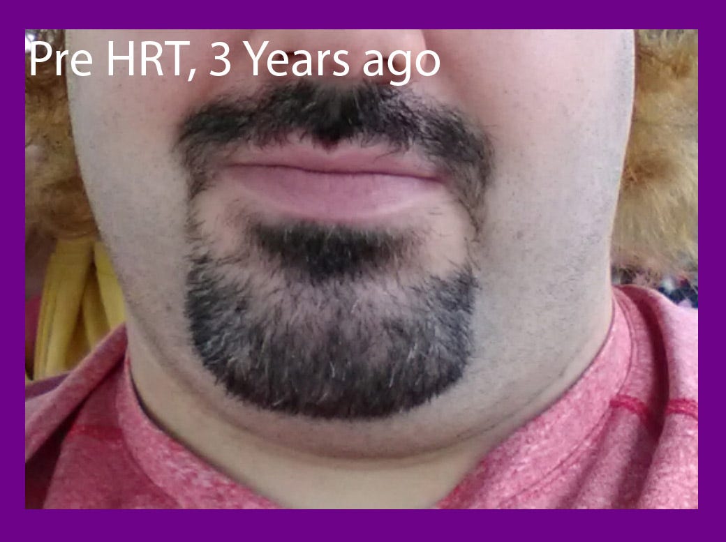 OMG!!! MTF effects and changes over the last….YEAR (Part 2) Facial Hair, by Beauty Girl, A Trans Life