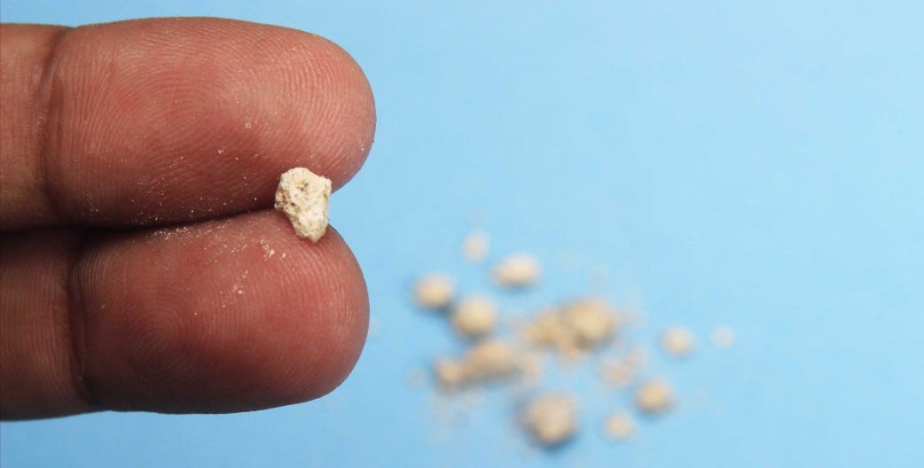Explainer: Drinking more water for kidney stones? Why it’s not enough