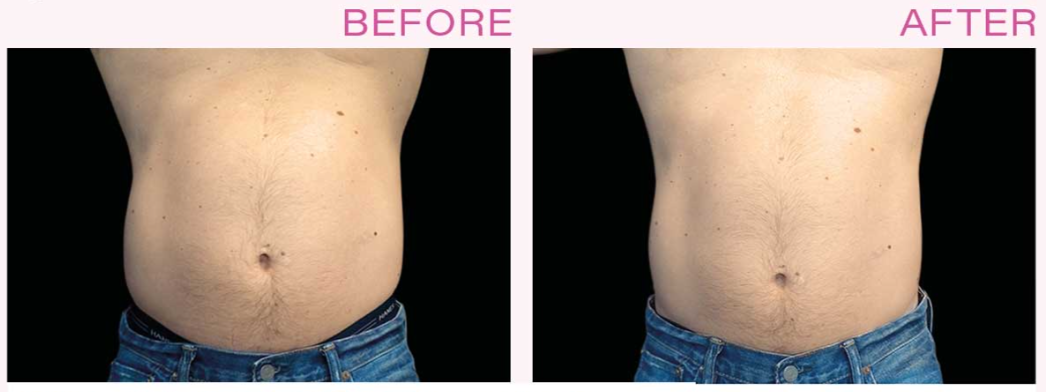 5 Possible Results From EMSCULPT Treatment, by ALLURE LASER STUDIO