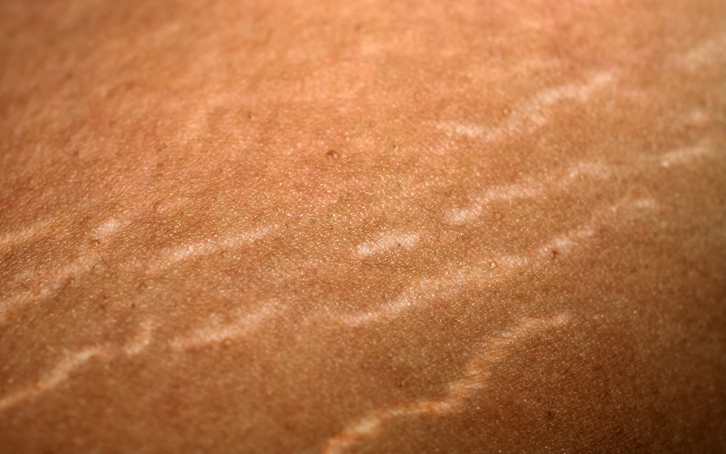 Stretch Marks on Breasts: What You Can Do?