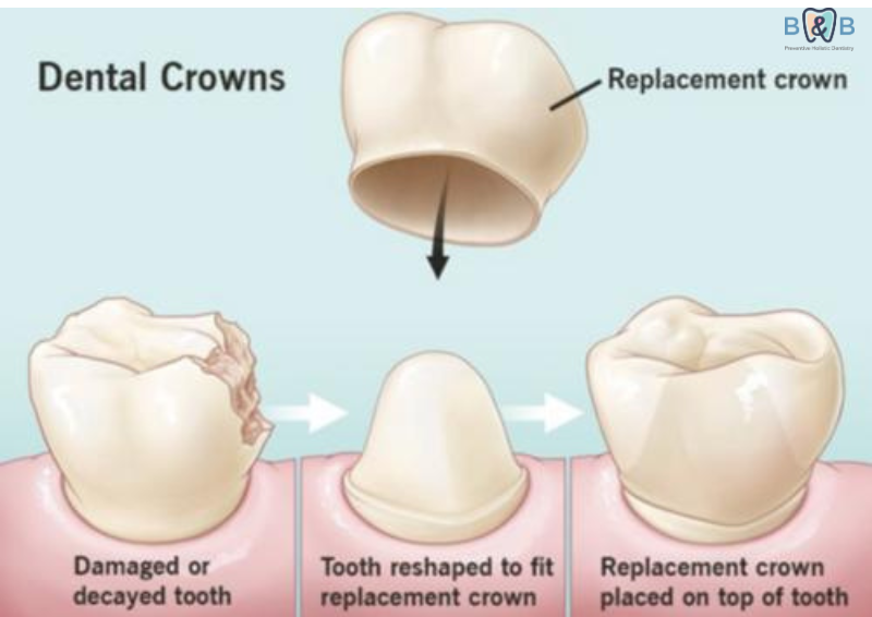 Dental crowns