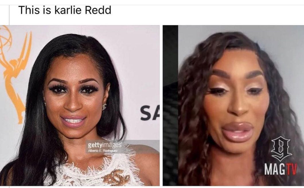 Female Reality TV Star Ruins Her Face With Botched Plastic Surgery