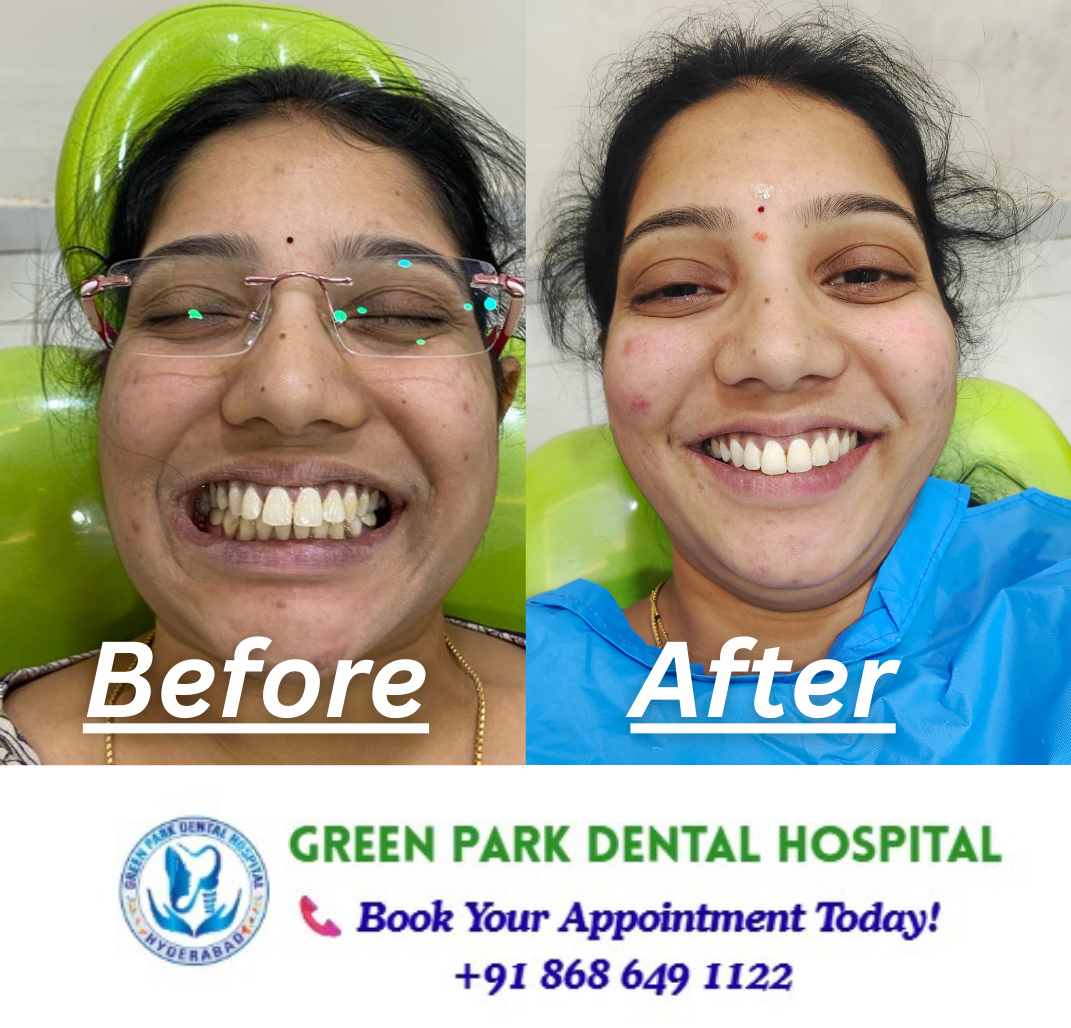 Invisalign Smile Transformation at Green Park Dental Hospital