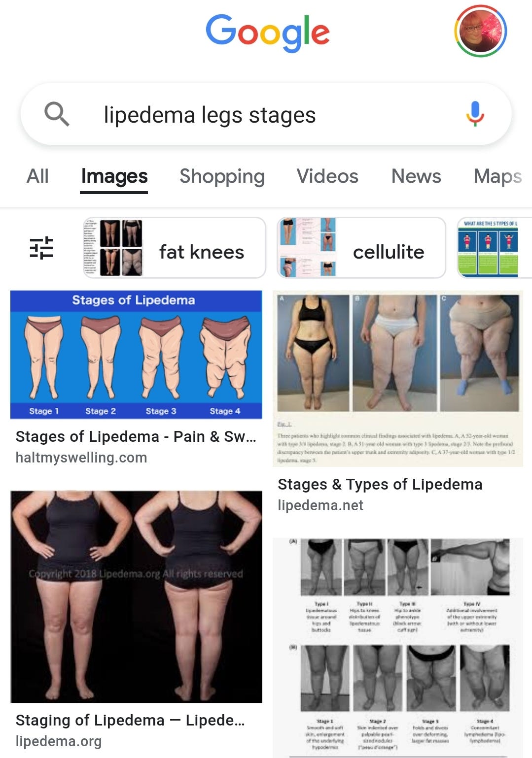 Women with lipedema have major health problems but wait decades