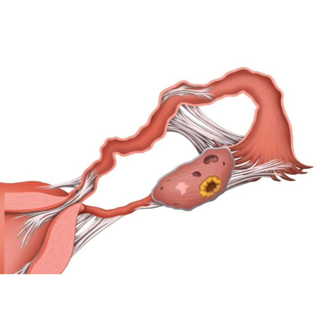 Enhancing IVF Success with the Clear Passage Approach® — Clear Passage