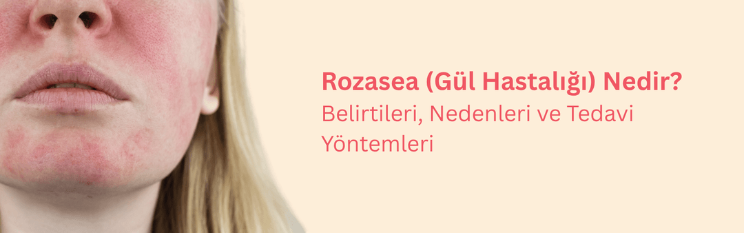 Gül Hastalığı (Rozasea) Nedir? Baş Etmenin Yolları