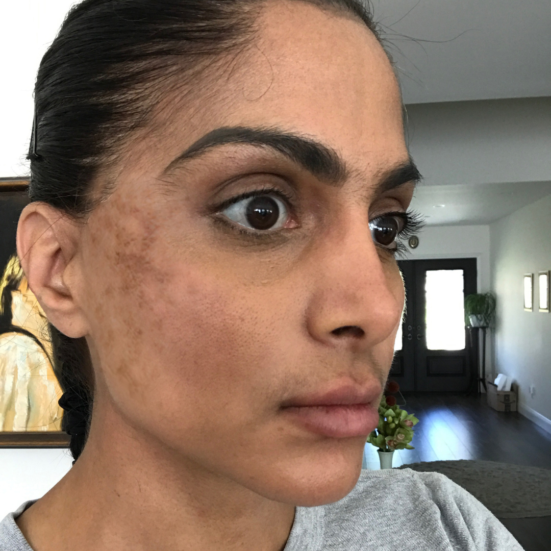 how-to-remove-dark-spots-on-face-overnight-by-hira-siddique-medium