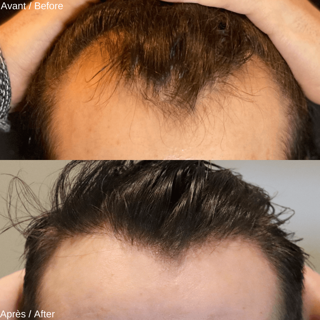 Achieve Natural Hair Restoration with Hair Transplant in Montreal