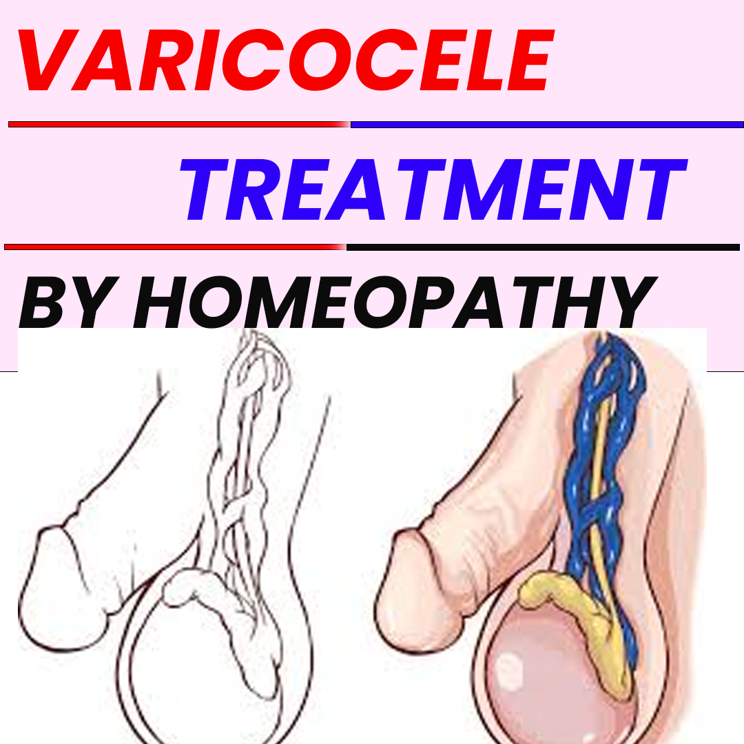 Empowering men to address varicocele and restore confidence, by bharat  homeopathy