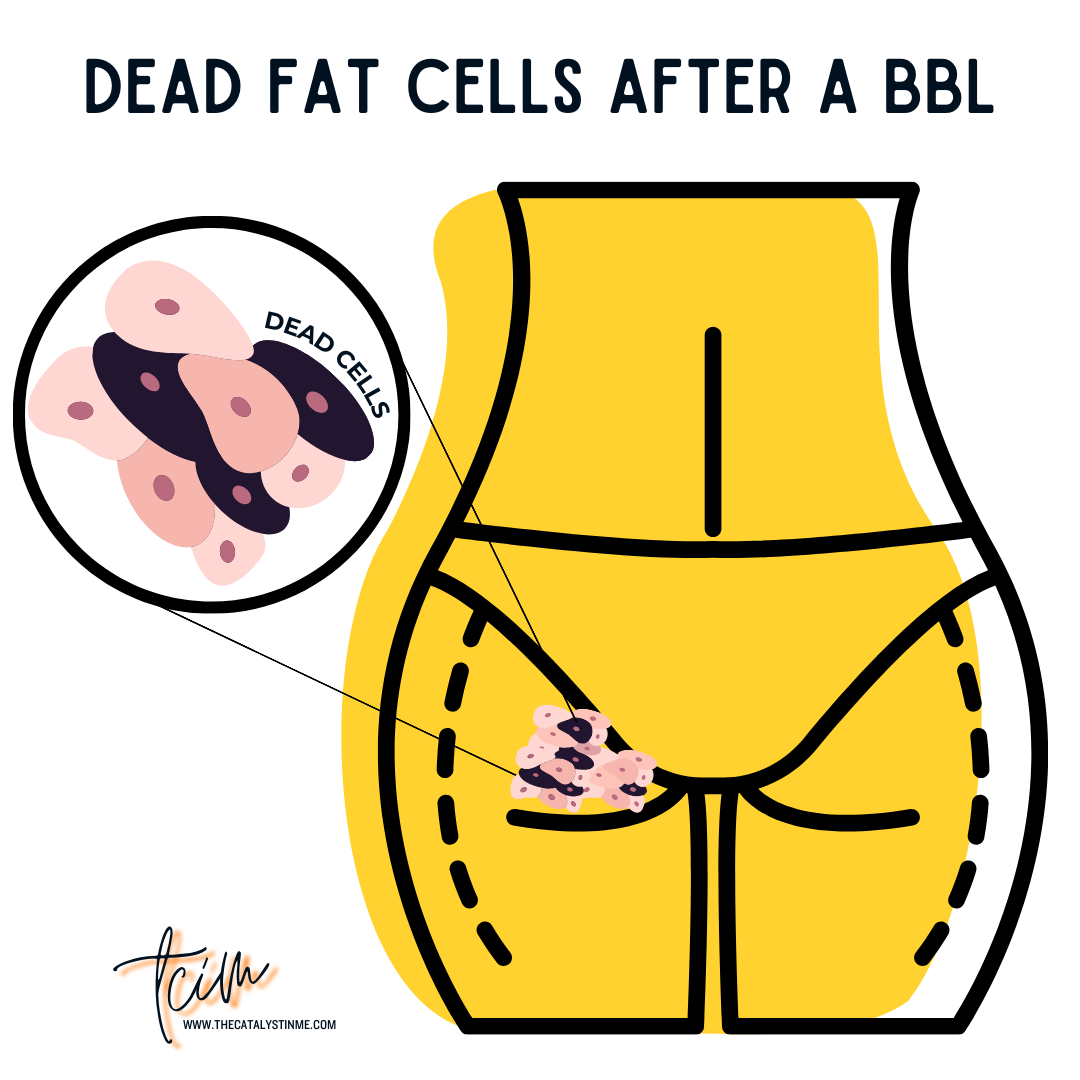 What happens to dead fat cells after a BBL?, by Adama