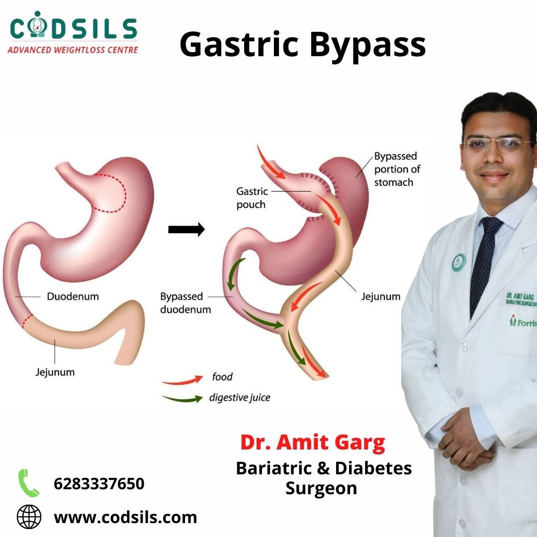 Dumping Syndrome Post Gastric Bypass Surgery In India By Dr Amit Garg Medium 