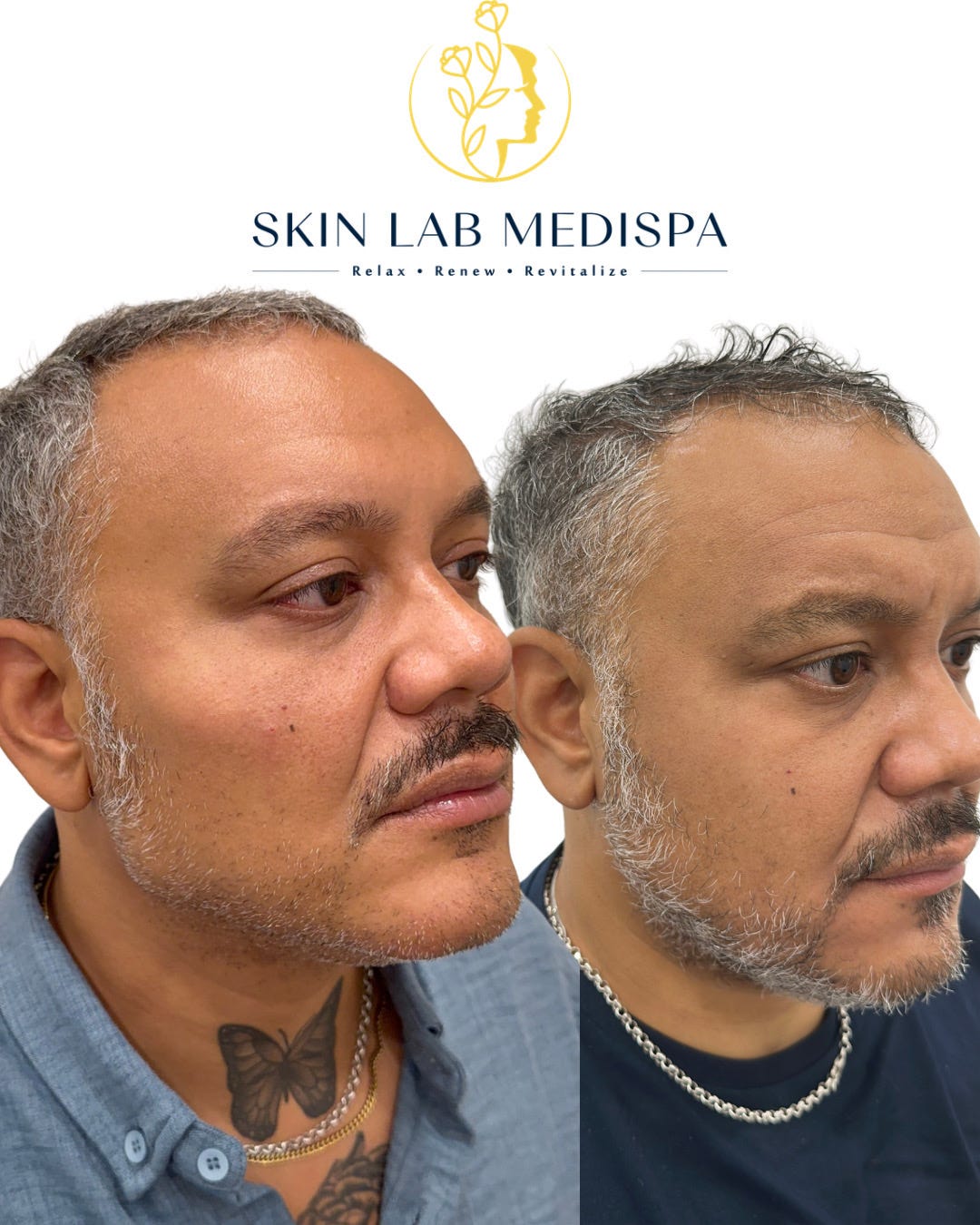 Male Facial Masculinisation in London — Real Results, What It Involves, and Why More Men Are…