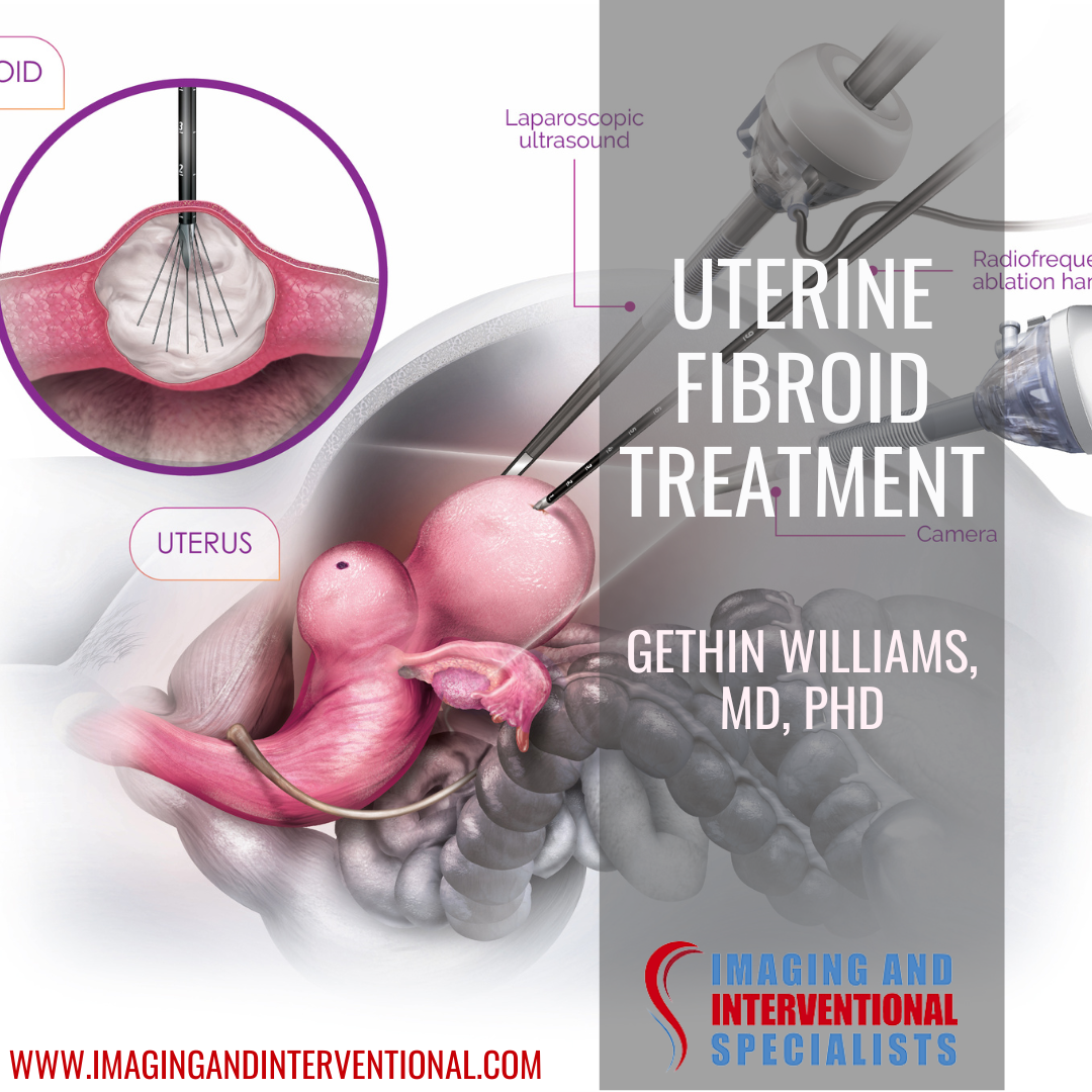 NonSurgical Hysterectomy Alternatives for Fibroids Medication