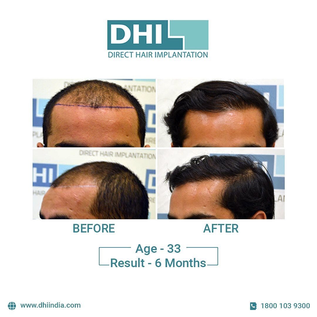Want to achieve lifetime results? The best hair transplant in Jaipur can  fulfill your dream! | by DHI India | Medium