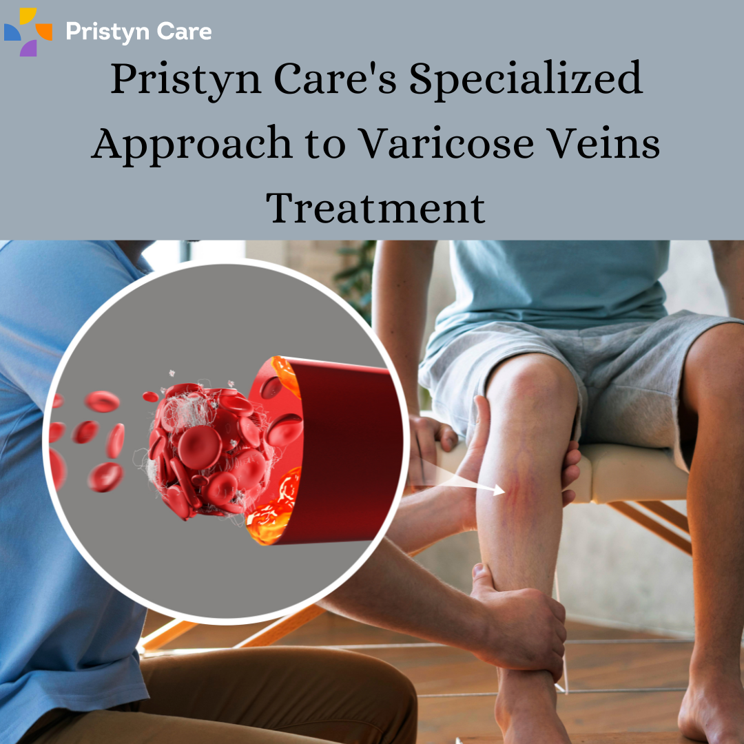 Top 10 ways to prevent varicose veins - Pristyn Care