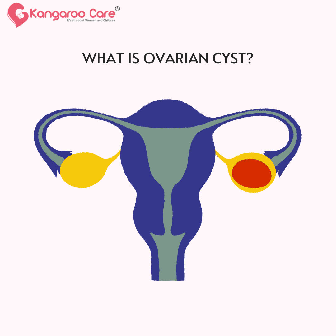 What is Ovarian Cyst?. Ovarian cysts are fluid-filled sacs… | by ...