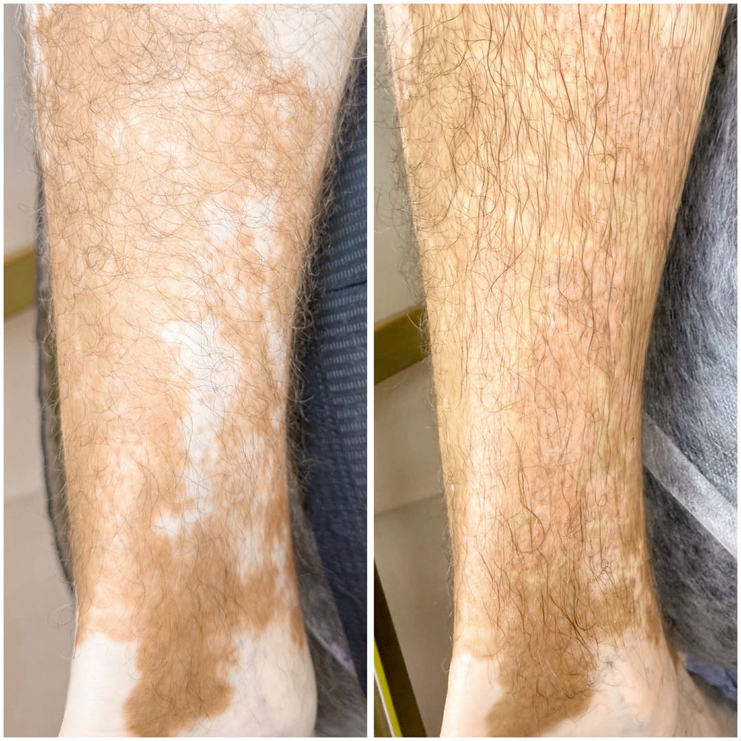 Paramedical Micropigmentation in Vitiligo: A Skin Camouflage Approach