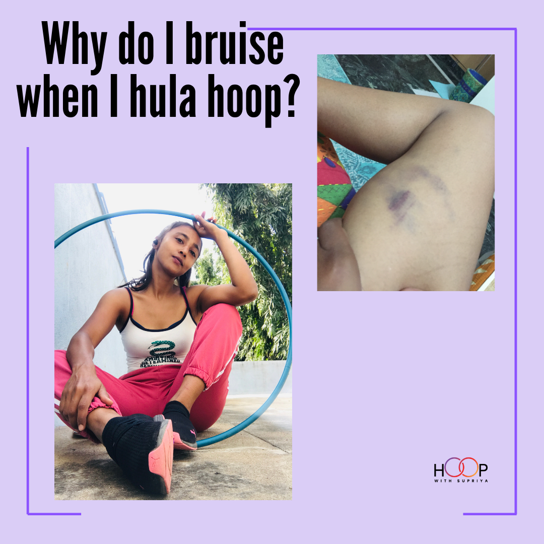 Why Do I Bruise when I Hula Hoop? | by Hoop With Supriya | Medium