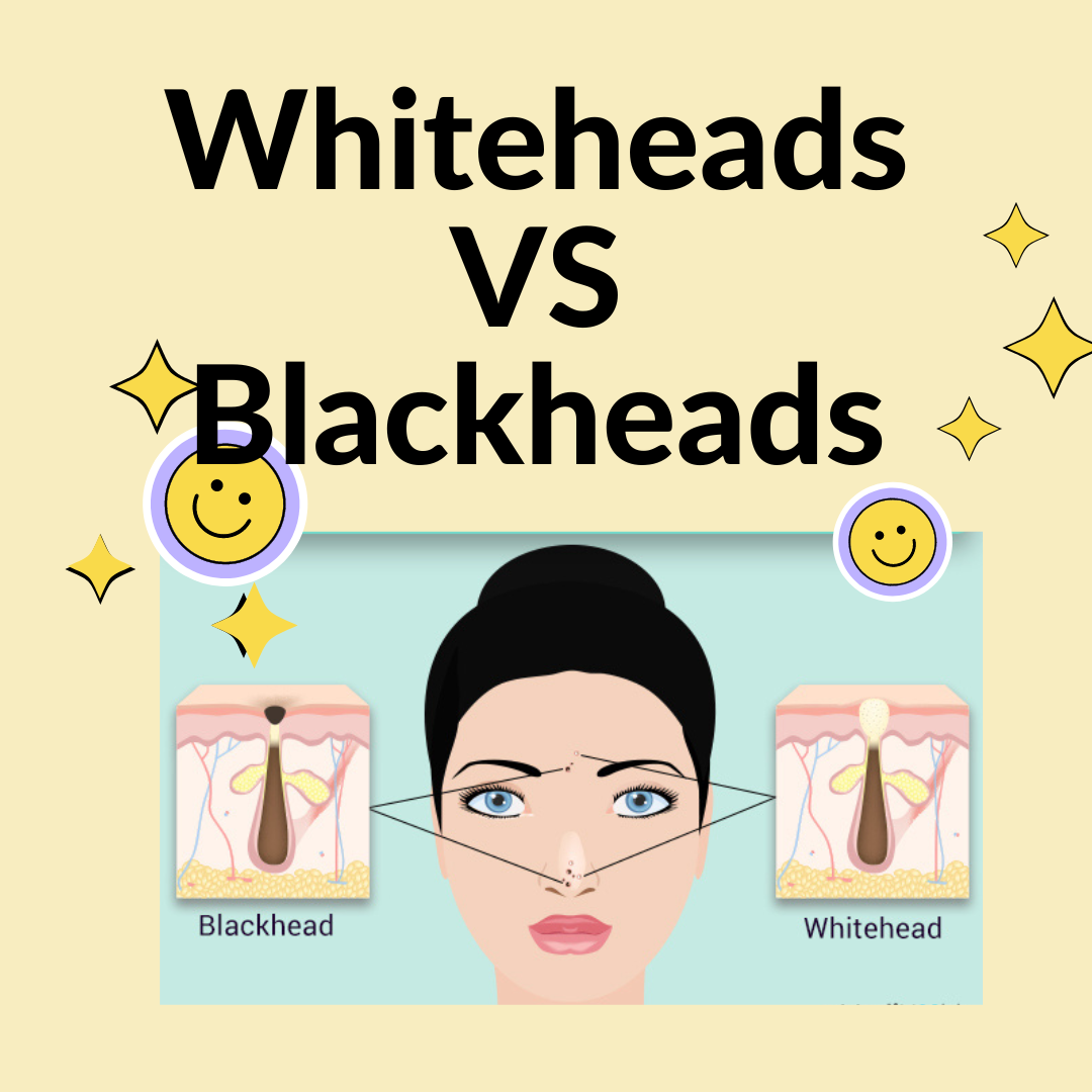 Whiteheads and blackheads. Whiteheads and blackheads are commonly… by