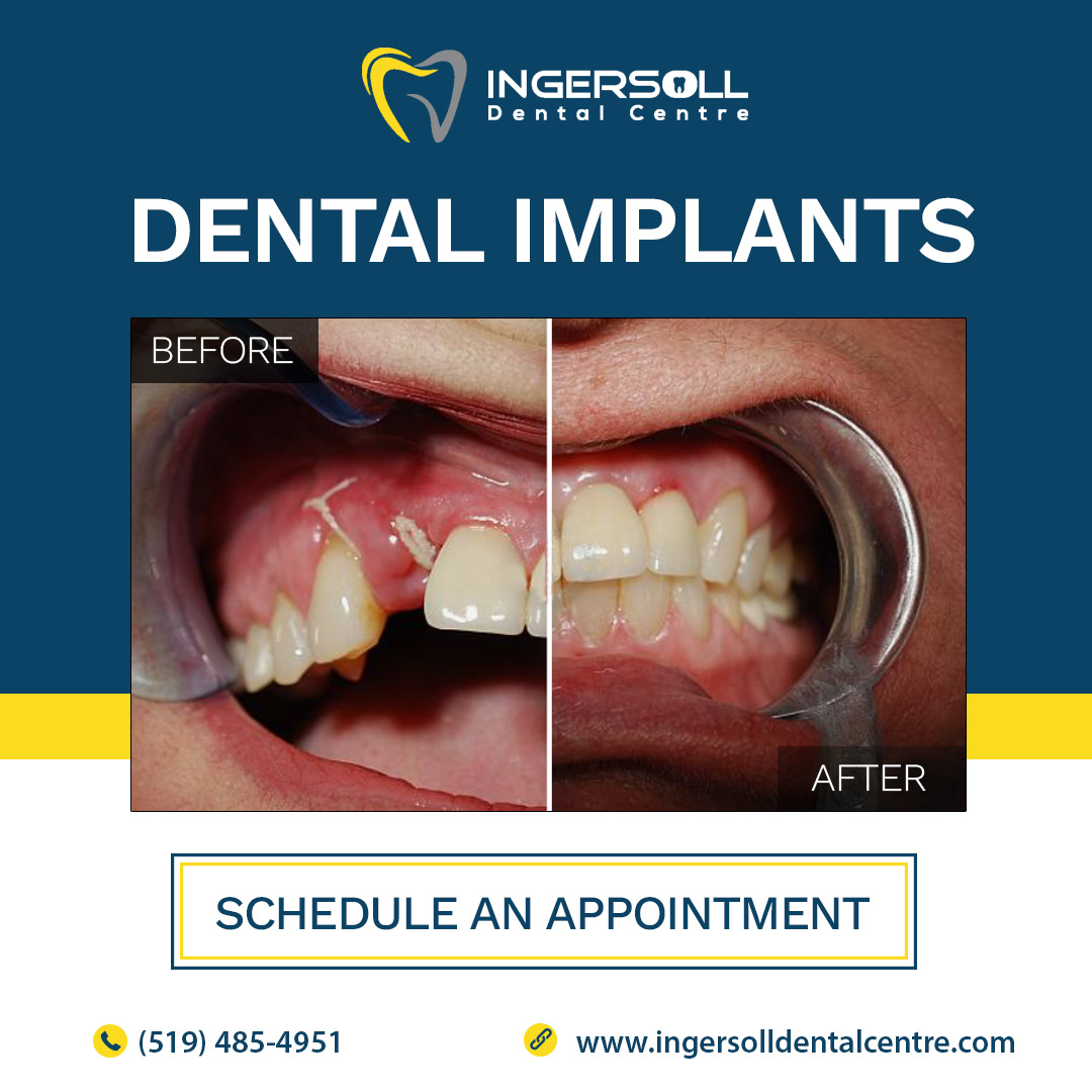 Why Does Dental Implant Ontario Take Such a Long Time? by INGERSOLL