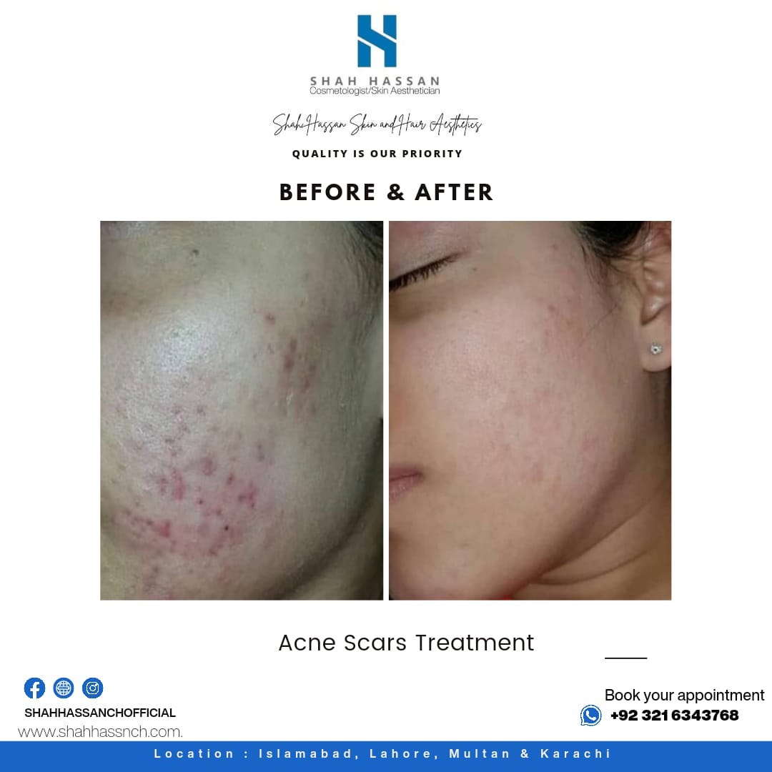 Acne Scars Treatment in Islamabad Shahhassanchowdry Medium