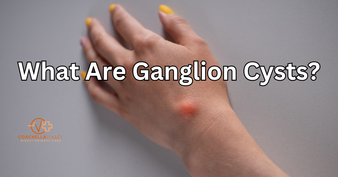 Understanding the Causes of Ganglion Cysts