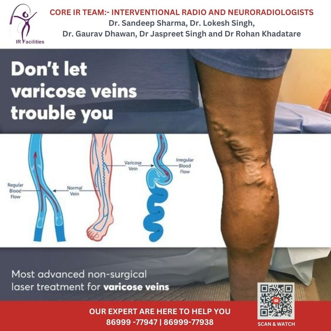Varicose Veins Treatment: A Q&A with UCSF Interventional