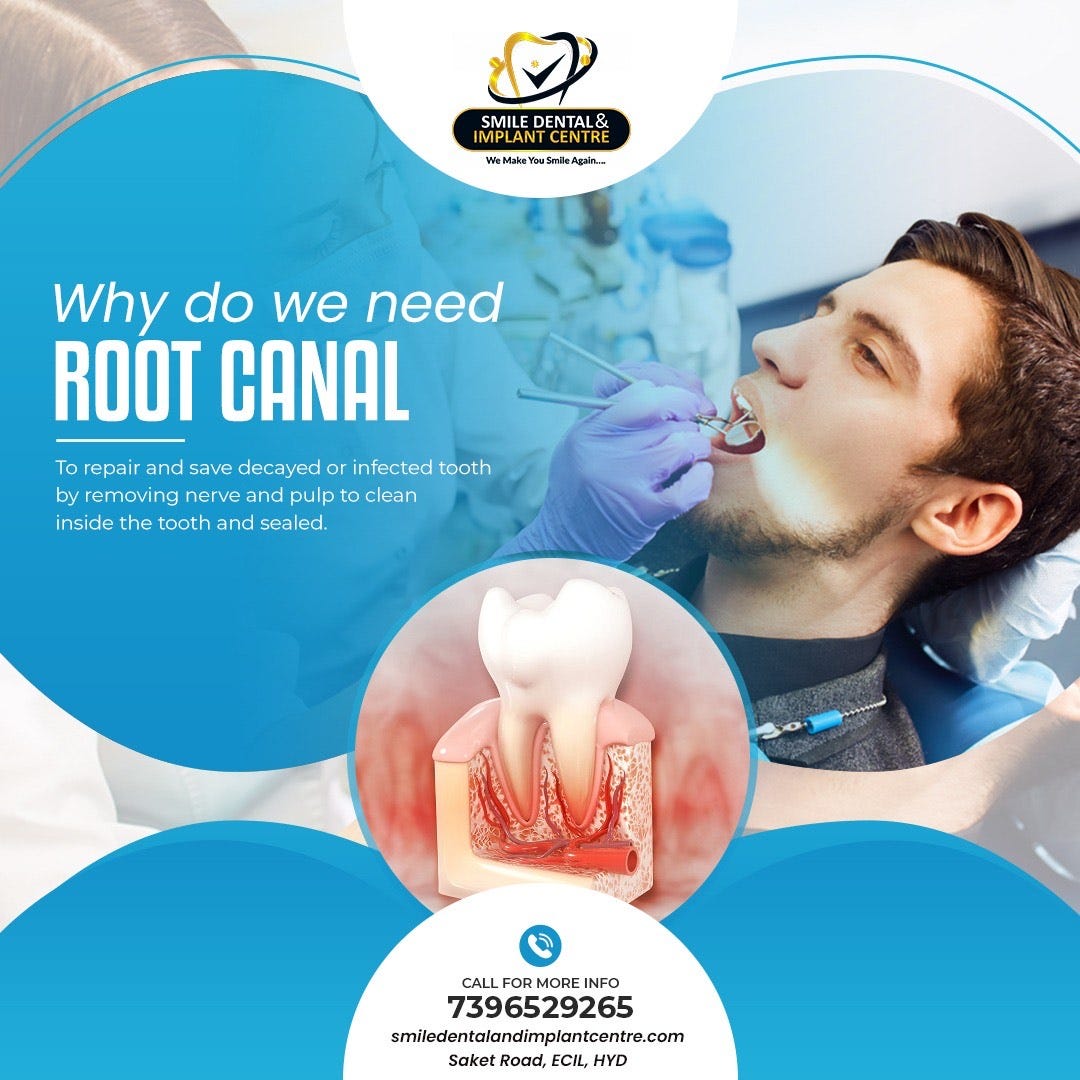How Much Does Root Canal Cost in Hyderabad? by Smile Dental and