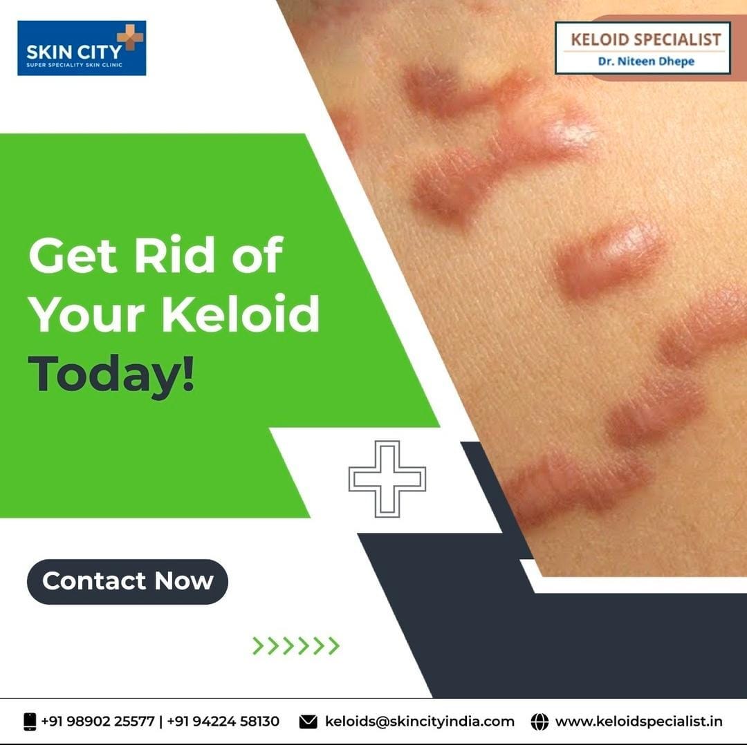 Keloid Specialist in Mumbai. Dr. Niteen Dhepe by Sanjana Verma Medium