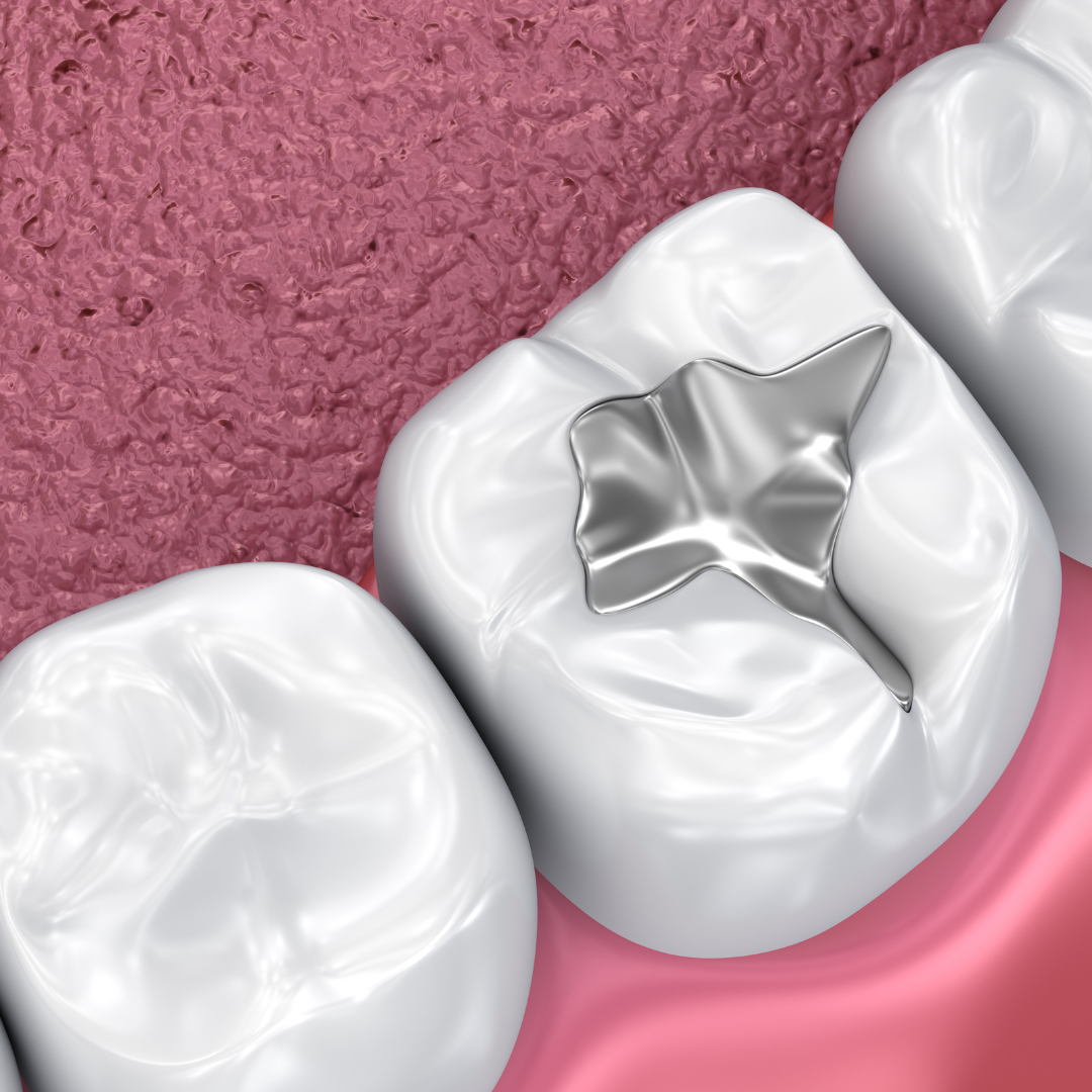 Comprehensive Shield The Wider Benefits of Fissure Sealants Beyond Cavities by Aelite Dental