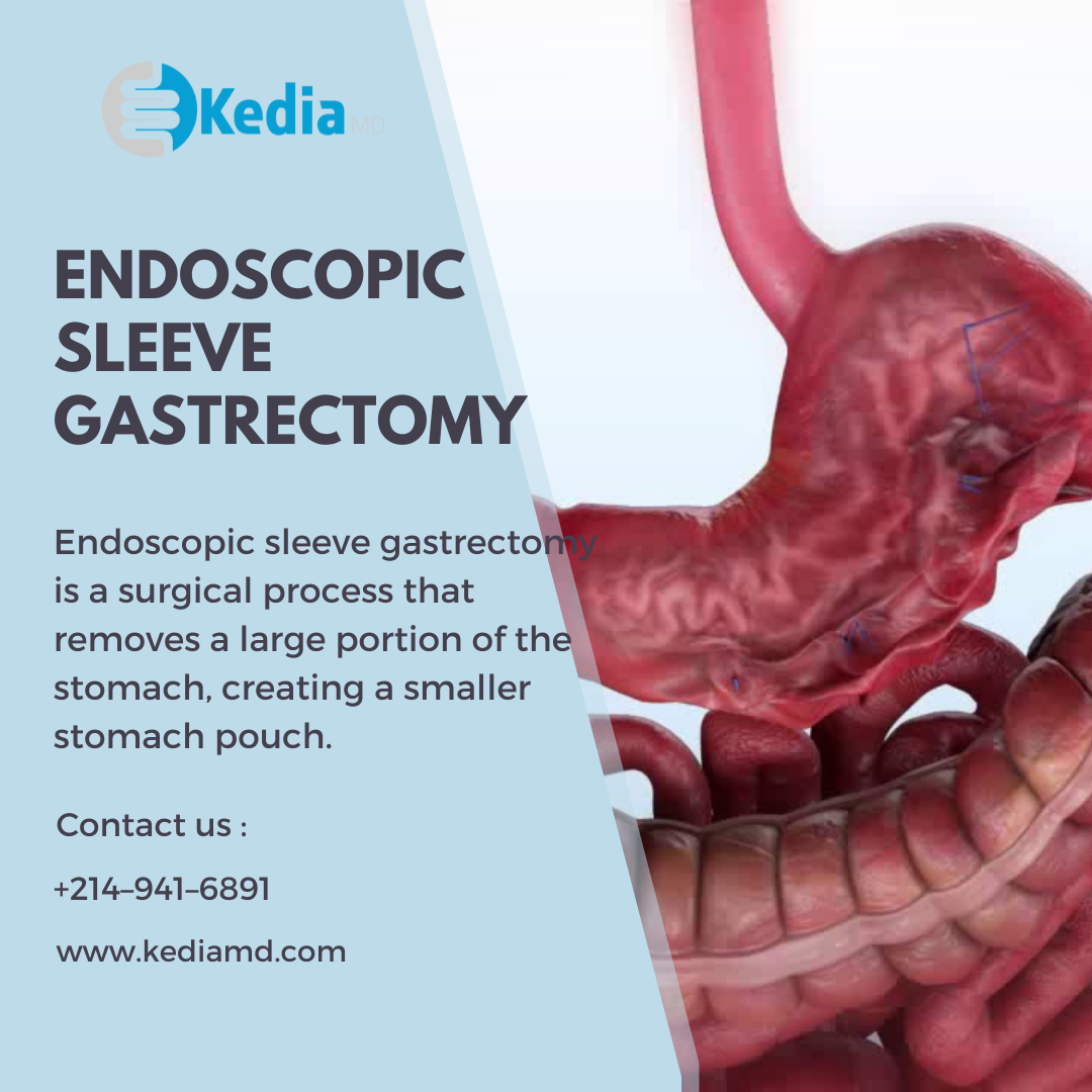 Endoscopic Sleeve Gastroplasty Best Doctor to get this Treatment in