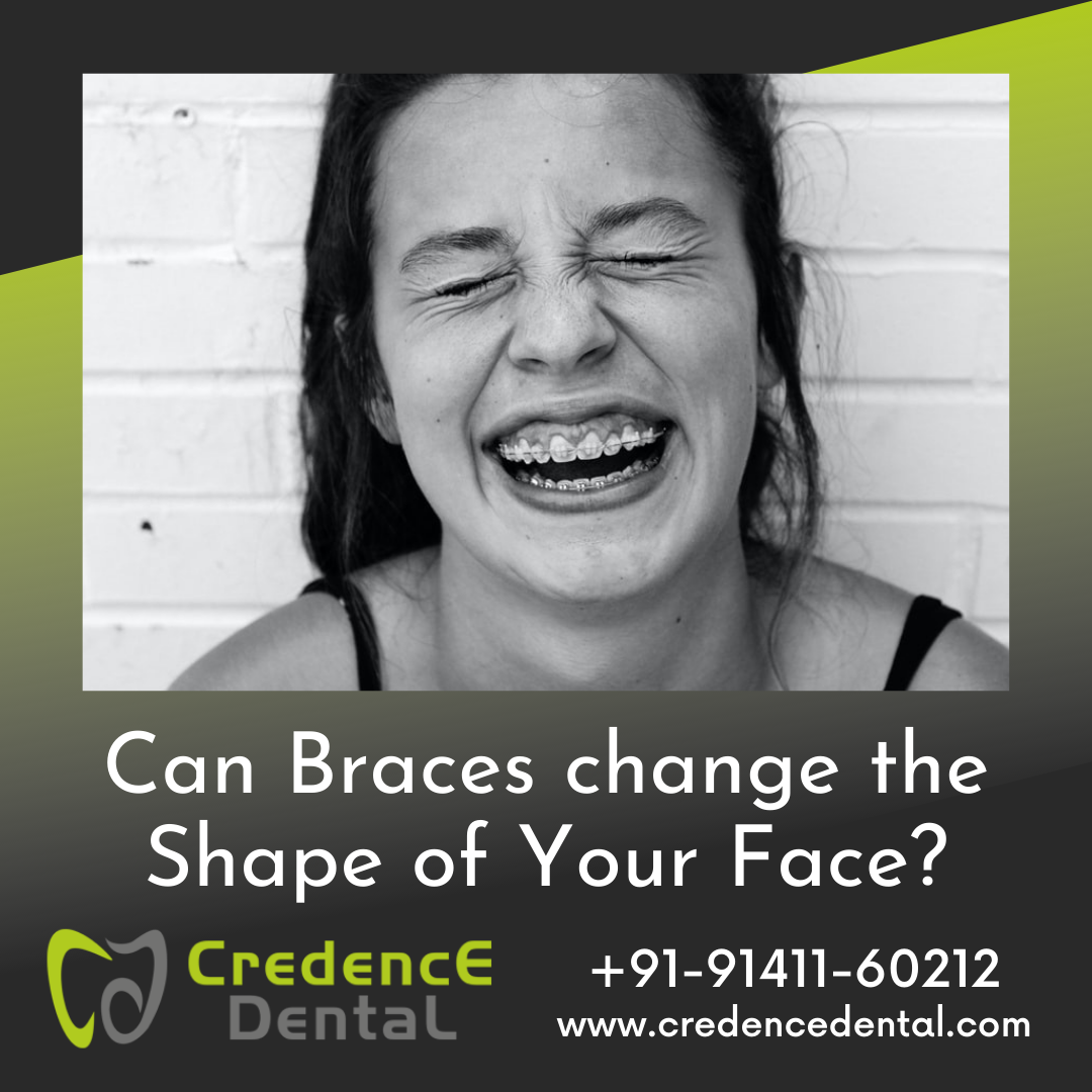 Can Braces Change Your Face Shape By Akshay Medium can-braces-change-your-face-shape-by-akshay-medium