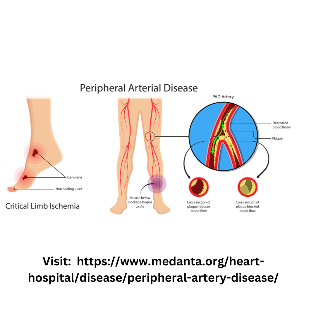 Peripheral Artery Disease PAD Symptoms Treatment Medanta By