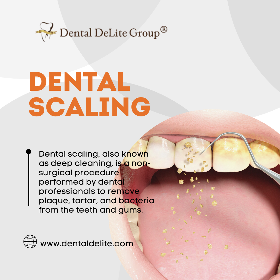 Achieving Optimal Oral Health Dental Scaling in Dallas, TX Explained