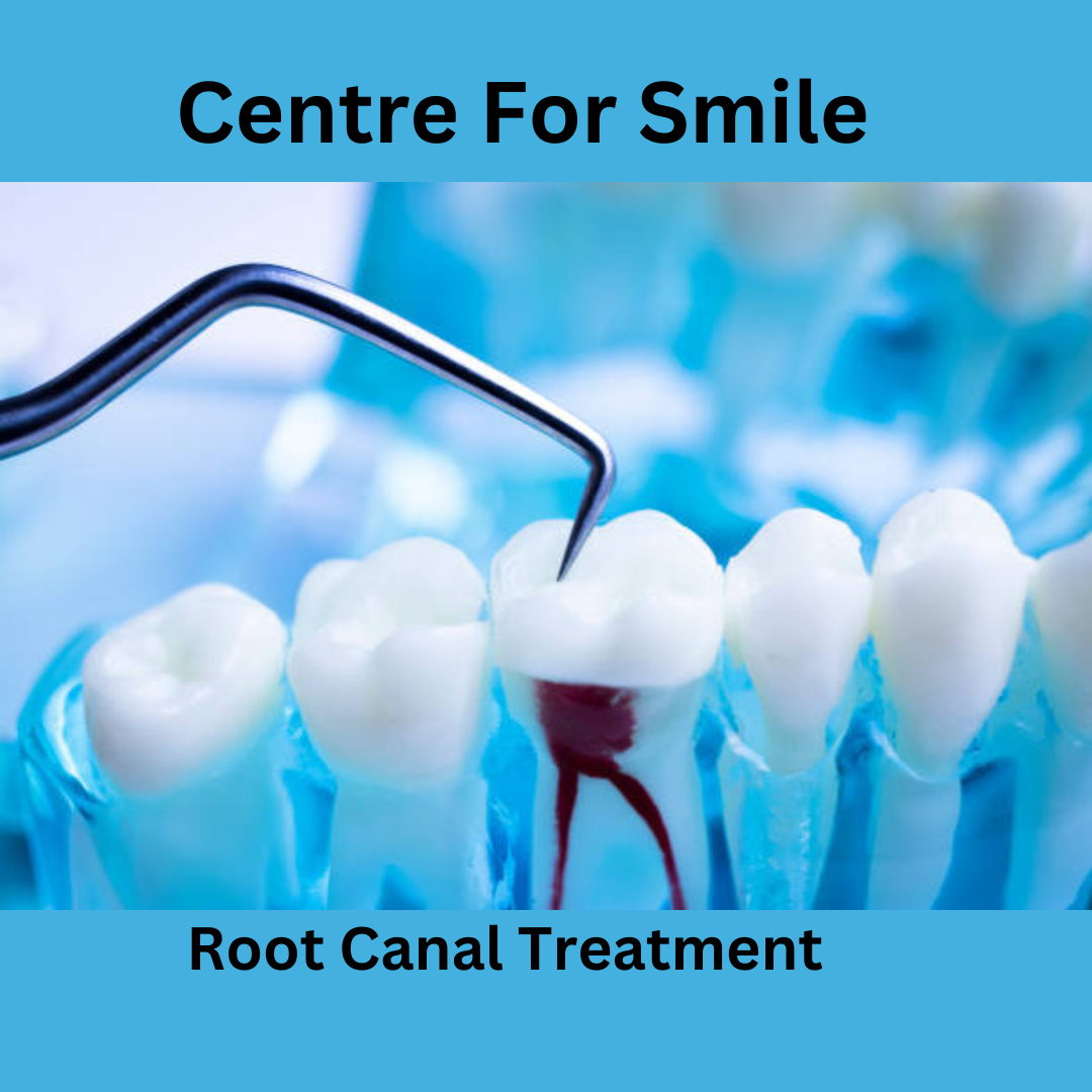 Root Canal Treatment. Has your dentist root canal… by