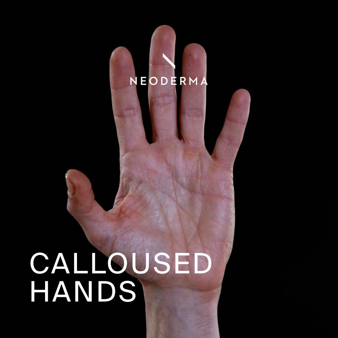 Calluses On Hands NEODERMA NEODERMA Medium